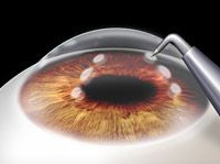 Cheap and Affordable Eye Treatment in India, Best Hospitals for Eye Treatment in India, Best Doctors for Eye Treatment in India , Medkaizen Global, Apollo Hospitals, Fortis Hospitals, Max Hospitals, Artemis Hospitals, Medanta Hospitals, Manipal Hospitals, Hospitals for Medical Tourism in India, Hospital for Medical Treatment in India, Hospitals for Surgery in India, Medical Tourism in India, Medical Treatment in India, Surgery in India, Medical Tourism Company