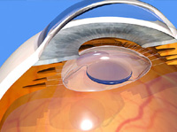 Cheap and Affordable Eye Treatment in India, Best Hospitals for Eye Treatment in India, Best Doctors for Eye Treatment in India , Medkaizen Global, Apollo Hospitals, Fortis Hospitals, Max Hospitals, Artemis Hospitals, Medanta Hospitals, Manipal Hospitals, Hospitals for Medical Tourism in India, Hospital for Medical Treatment in India, Hospitals for Surgery in India, Medical Tourism in India, Medical Treatment in India, Surgery in India, Medical Tourism Company