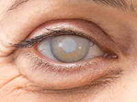 Cheap and Affordable Eye Treatment in India, Best Hospitals for Eye Treatment in India, Best Doctors for Eye Treatment in India , Medkaizen Global, Apollo Hospitals, Fortis Hospitals, Max Hospitals, Artemis Hospitals, Medanta Hospitals, Manipal Hospitals, Hospitals for Medical Tourism in India, Hospital for Medical Treatment in India, Hospitals for Surgery in India, Medical Tourism in India, Medical Treatment in India, Surgery in India, Medical Tourism Company