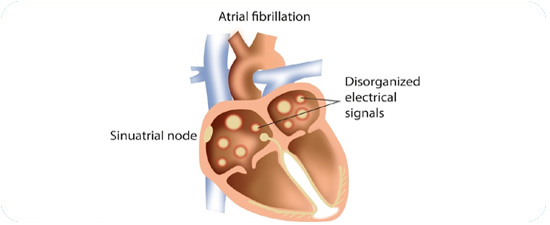 Cheap and Affordable Heart Surgery in India, Best Hospitals for Heart Surgery in India, Best Doctors for Heart Surgery in India , Medkaizen Global, Apollo Hospitals, Fortis Hospitals, Max Hospitals, Artemis Hospitals, Medanta Hospitals, Manipal Hospitals, Hospitals for Medical Tourism in India, Hospital for Medical Treatment in India, Hospitals for Surgery in India, Medical Tourism in India, Medical Treatment in India, Surgery in India, Medical Tourism Company