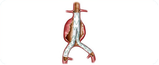 Cheap and Affordable Heart Surgery in India, Best Hospitals for Heart Surgery in India, Best Doctors for Heart Surgery in India , Medkaizen Global, Apollo Hospitals, Fortis Hospitals, Max Hospitals, Artemis Hospitals, Medanta Hospitals, Manipal Hospitals, Hospitals for Medical Tourism in India, Hospital for Medical Treatment in India, Hospitals for Surgery in India, Medical Tourism in India, Medical Treatment in India, Surgery in India, Medical Tourism Company