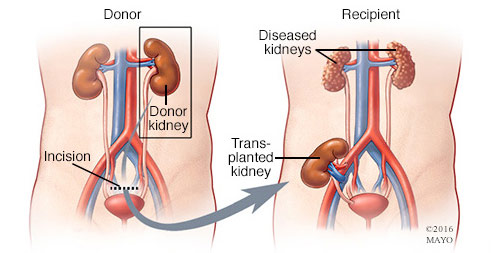 Cheap and Affordable Kidney Transplant in India, Best Hospitals for Kidney Transplant in India, Best Doctors for Kidney Transplant in India , Medkaizen Global, Apollo Hospitals, Fortis Hospitals, Max Hospitals, Artemis Hospitals, Medanta Hospitals, Manipal Hospitals, Hospitals for Medical Tourism in India, Hospital for Medical Treatment in India, Hospitals for Surgery in India, Medical Tourism in India, Medical Treatment in India, Surgery in India, Medical Tourism Company