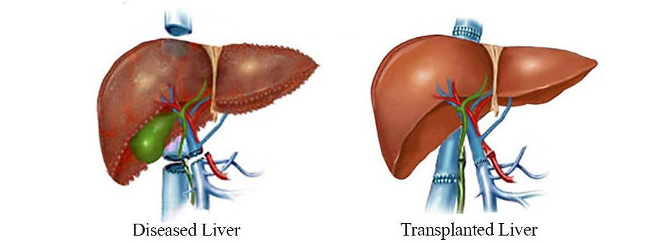 Cheap and Affordable Liver Transplant in India, Best Hospitals for Liver Transplant in India, Best Doctors for Liver Transplant in India , Medkaizen Global, Apollo Hospitals, Fortis Hospitals, Max Hospitals, Artemis Hospitals, Medanta Hospitals, Manipal Hospitals, Hospitals for Medical Tourism in India, Hospital for Medical Treatment in India, Hospitals for Surgery in India, Medical Tourism in India, Medical Treatment in India, Surgery in India, Medical Tourism Company