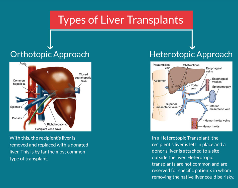 Cheap and Affordable Liver Transplant in India, Best Hospitals for Liver Transplant in India, Best Doctors for Liver Transplant in India , Medkaizen Global, Apollo Hospitals, Fortis Hospitals, Max Hospitals, Artemis Hospitals, Medanta Hospitals, Manipal Hospitals, Hospitals for Medical Tourism in India, Hospital for Medical Treatment in India, Hospitals for Surgery in India, Medical Tourism in India, Medical Treatment in India, Surgery in India, Medical Tourism Company