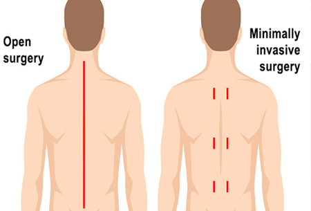 Cheap and Affordable Spine Surgery in India, Best Hospitals for Spine Surgery in India, Best Doctors for Spine Surgery in India , Medkaizen Global, Apollo Hospitals, Fortis Hospitals, Max Hospitals, Artemis Hospitals, Medanta Hospitals, Manipal Hospitals, Hospitals for Medical Tourism in India, Hospital for Medical Treatment in India, Hospitals for Surgery in India, Medical Tourism in India, Medical Treatment in India, Surgery in India, Medical Tourism Company