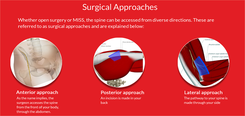 Cheap and Affordable Spine Surgery in India, Best Hospitals for Spine Surgery in India, Best Doctors for Spine Surgery in India , Medkaizen Global, Apollo Hospitals, Fortis Hospitals, Max Hospitals, Artemis Hospitals, Medanta Hospitals, Manipal Hospitals, Hospitals for Medical Tourism in India, Hospital for Medical Treatment in India, Hospitals for Surgery in India, Medical Tourism in India, Medical Treatment in India, Surgery in India, Medical Tourism Company